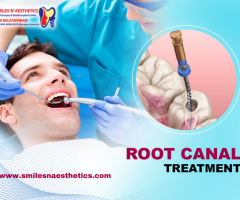 Root Canal Treatment In HSR Layout: Smiles N Aesthetics