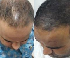 Looking Hair Transplant Clinic in Lajpat Nagar Delhi