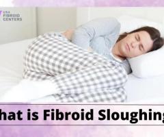 What is Fibroid Sloughing?