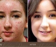 BBL Laser Therapy & IPL Photofacial | Hidden Door Spa