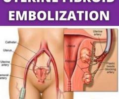 Uterine Fibroid Embolization (UFE) Procedure: Advanced Minimally Invasive Treatment