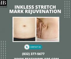 How Many Treatments Does It Take To Remove Inkless Stretch Marks?