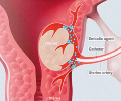 Uterine Fibroid Embolization (UFE) for Fibroids: A Minimally Invasive Treatment