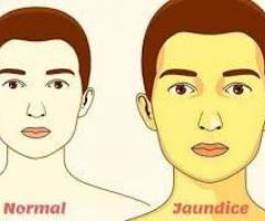 Symptoms, Causes, and Treatment of Jaundice