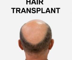 Hair transplant services in Pakistan - 1