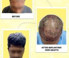 Vampire Facelift Treatment in Kochi: Natural Skin Rejuvenation with PRP Therapy