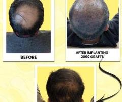 Vampire Facelift Treatment in Kochi: Natural Skin Rejuvenation with PRP Therapy