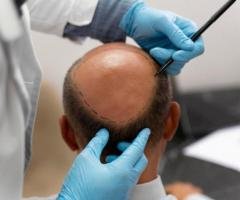 Hair Restoration in Ernakulam – Advanced Treatments for Healthy Hair Growth