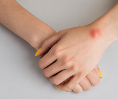What are the best ways to get rid of lipoma without surgery?