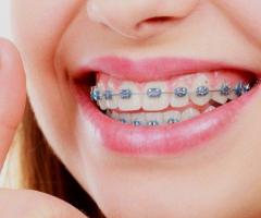 Best Orthodontist in Pune | Orthodontist near me in Pimpri Chinchwad | Affordable Braces Treatment