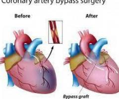 Bypass Surgery: Procedure, Types, Risks, and Recovery