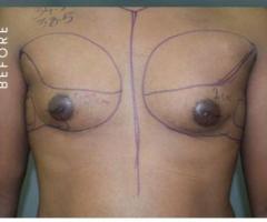 best gynecomastia surgery - 1
