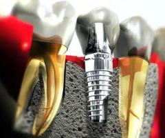 Best Dental Implants in Pune | Affordable tooth Implants in Pimpri Chinchwad | Best Implantologist