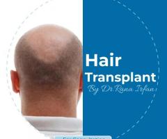 Hair transplant Services by dr rana Irfan at vagus cosmetic Islamabad