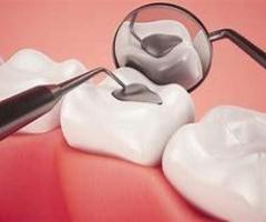 Best Dental Filling in Pune | Dental Filling Near Me | Pathak Dental Clinic