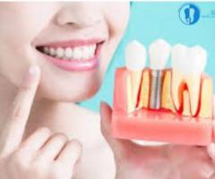 Dental implants in chennai - Sendhil Dental