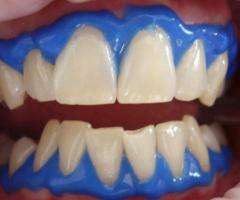 Teeth Whitening Options at the Best Dental Clinic in Pimpri Chinchwad, Pune