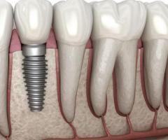 Best Dental Implants in Pune | Affordable tooth Implants in Pimpri Chinchwad