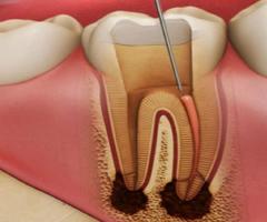 Painless Root Canal Treatment in Pune, pimpri-chinchwad | Affordable Root Canal Treatment near me