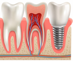 Best Full-Mouth Dental Implant Specialist in Bangalore