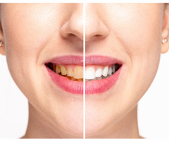 Get whiter teeth in just 9 minutes a day