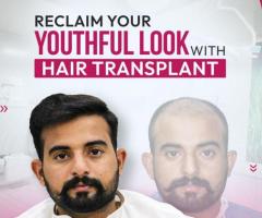 Hair Transplant Service by Dr Rana Irfan in Islamabad, Pakistan