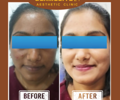 Best Skin Whitening Treatment in Hinjewadi Pune