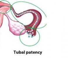 Diagnostic laparoscopy for tubal patency - Dr. Rohit Luthra