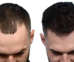 Best Hair Transplant Clinic in Kochi: Choosing the Right Hair Restoration Specialist