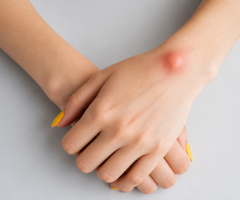 What Should You Know About Lipoma Removal Without Surgery?