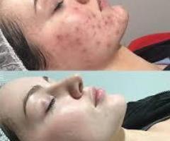 Acne Scar Treatment Hinjewadi | Acne Treatment in Pimpri Chinchwad pune