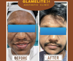 Skin Pigmentation Treatment in Pune | Skin Pigmentation in Hinjewadi