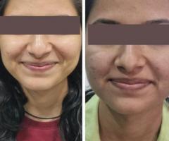 Skin Polishing Treatment in Pune, Pimpri Chinchwad | Skin Polishing Treatment Hinjewadi