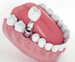 Get The Dental Implant| Springvale Dental Clinic
