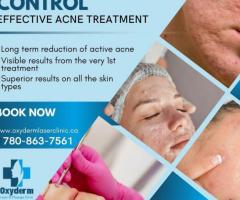 Laser acne treatment clinic in Edmonton - Oxyderm Laser Clinic
