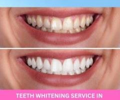 Professional Teeth Whitening Service in Madinaguda for Bright Smile