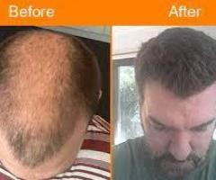 Best Hair Transplant in Pune| Clinique Intarnationale