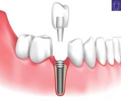 Implant teeth price in Malaysia