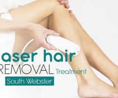 Laser Hair Removal Treatment South Webster - 1